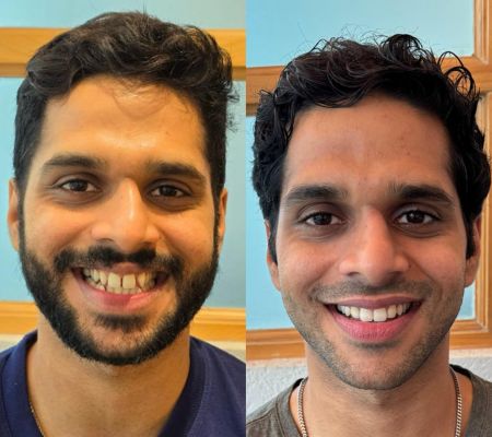 Before & After Transformation 4