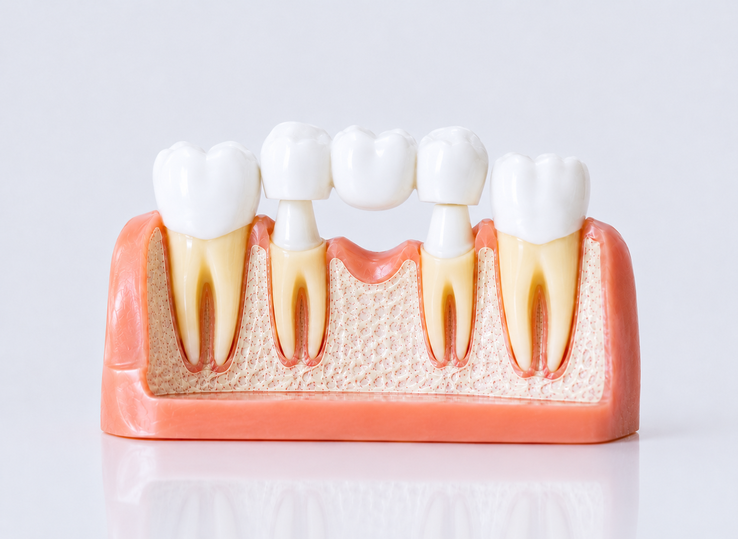 Dental Crowns & Bridges – Dr. Devanand Shetty, Bandra Mumbai