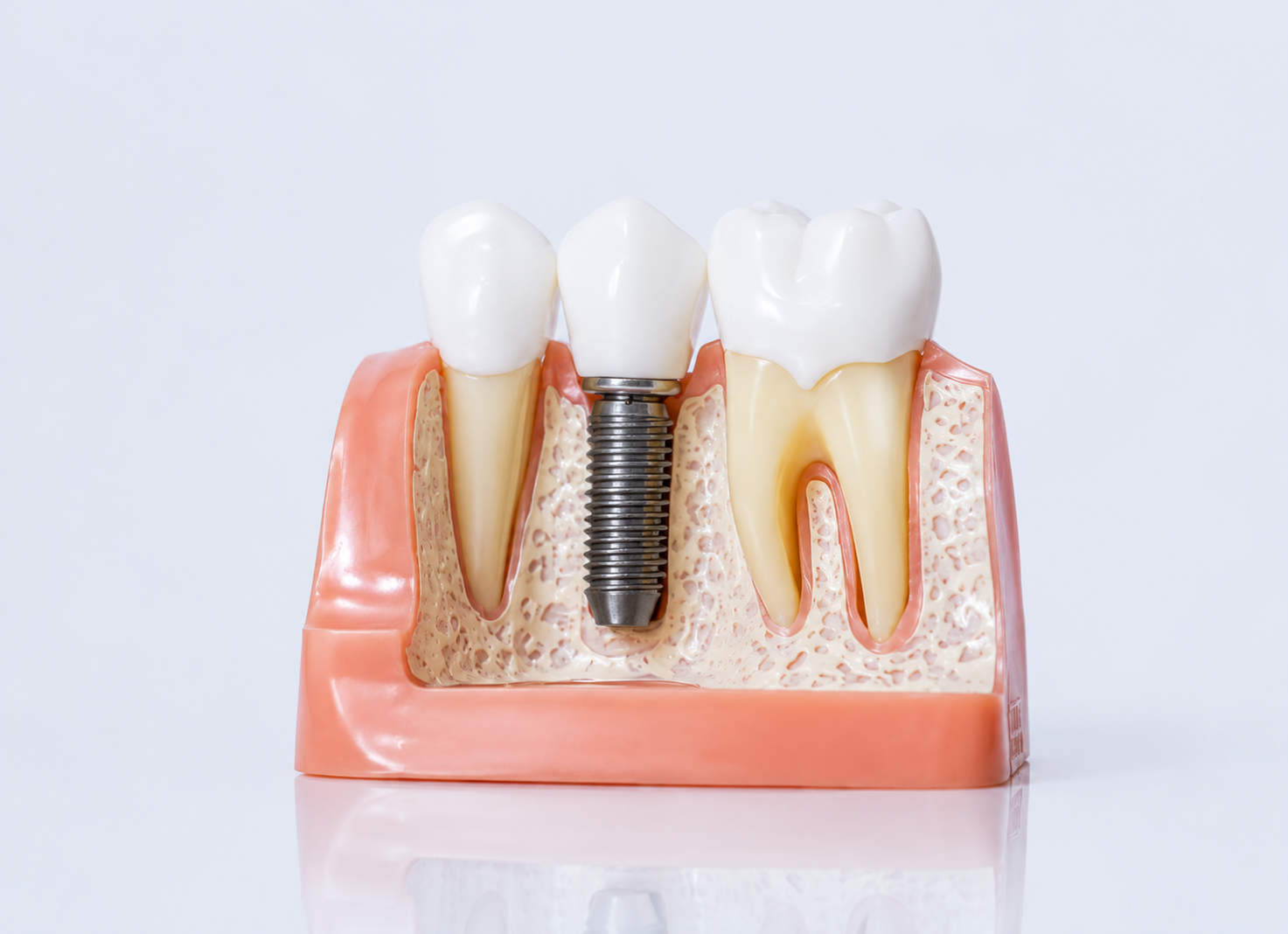 Best Dental Implants Clinic in Bandra Mumbai