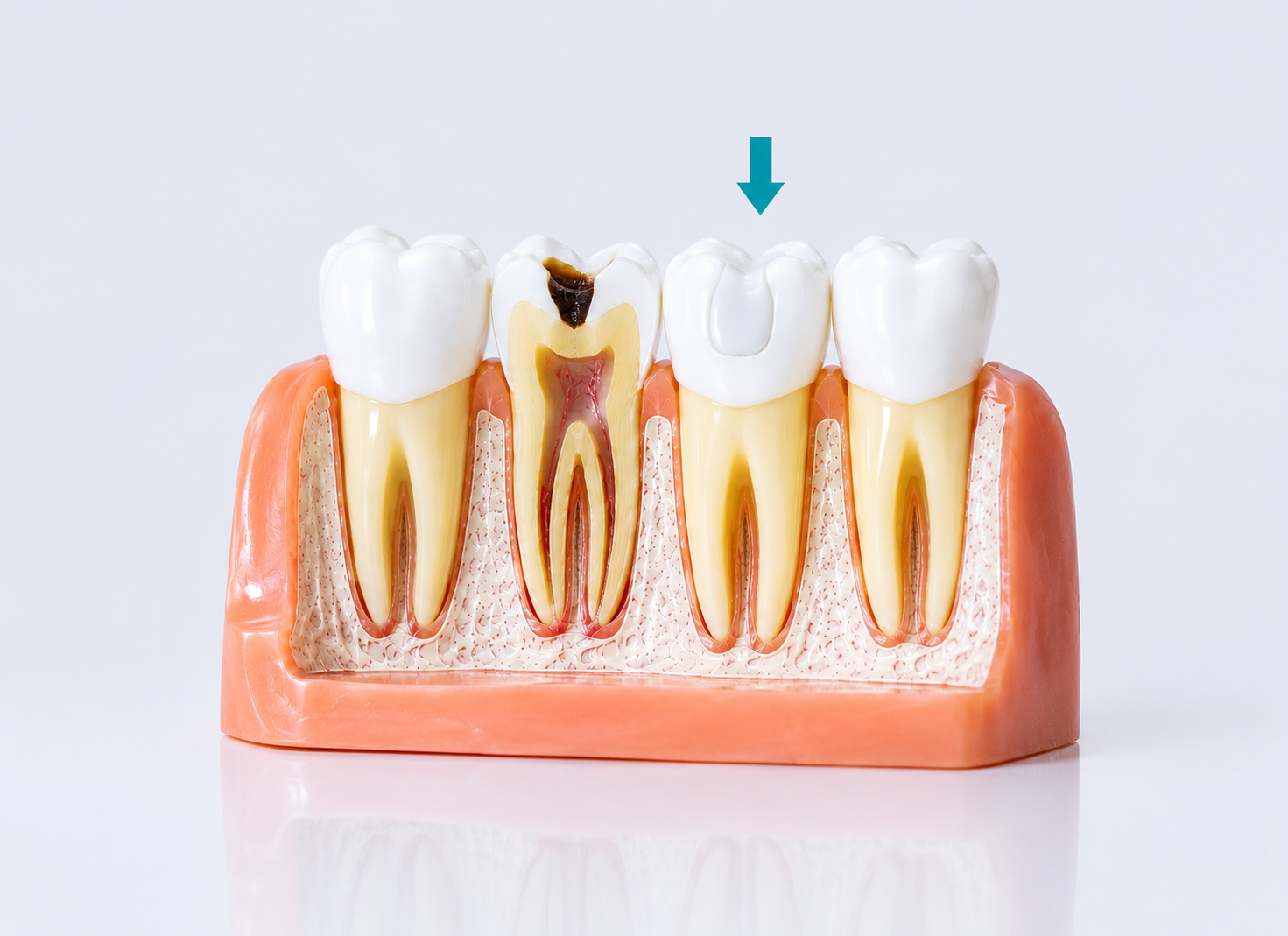 Fillings