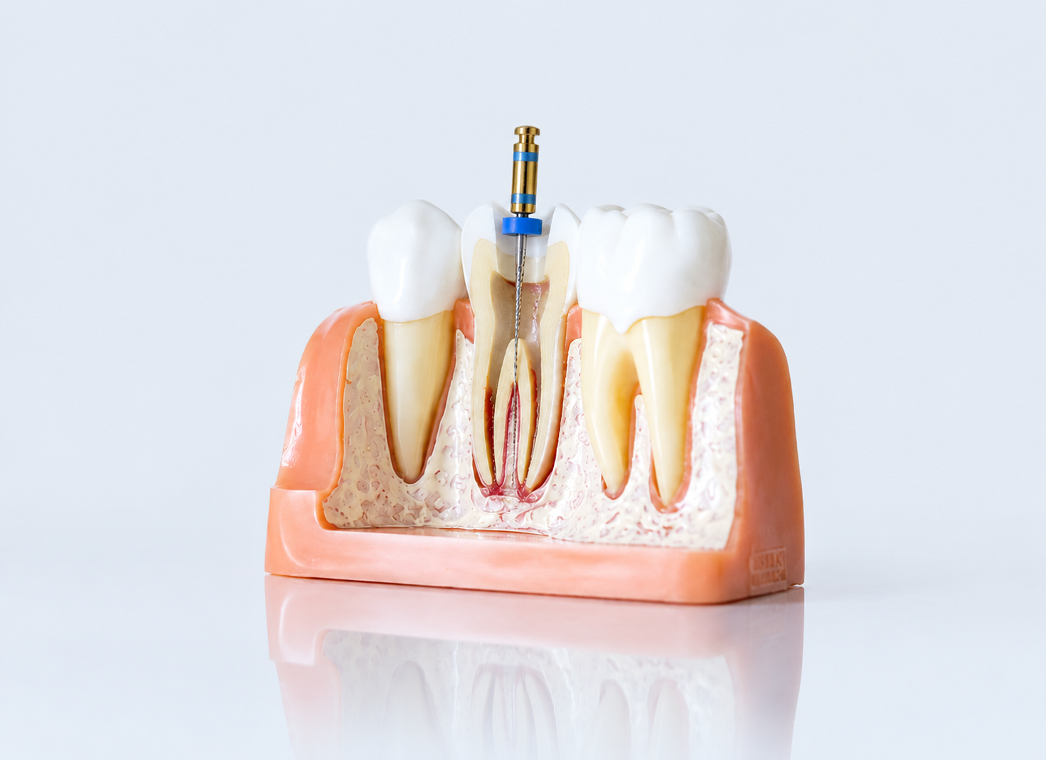  Root Canals